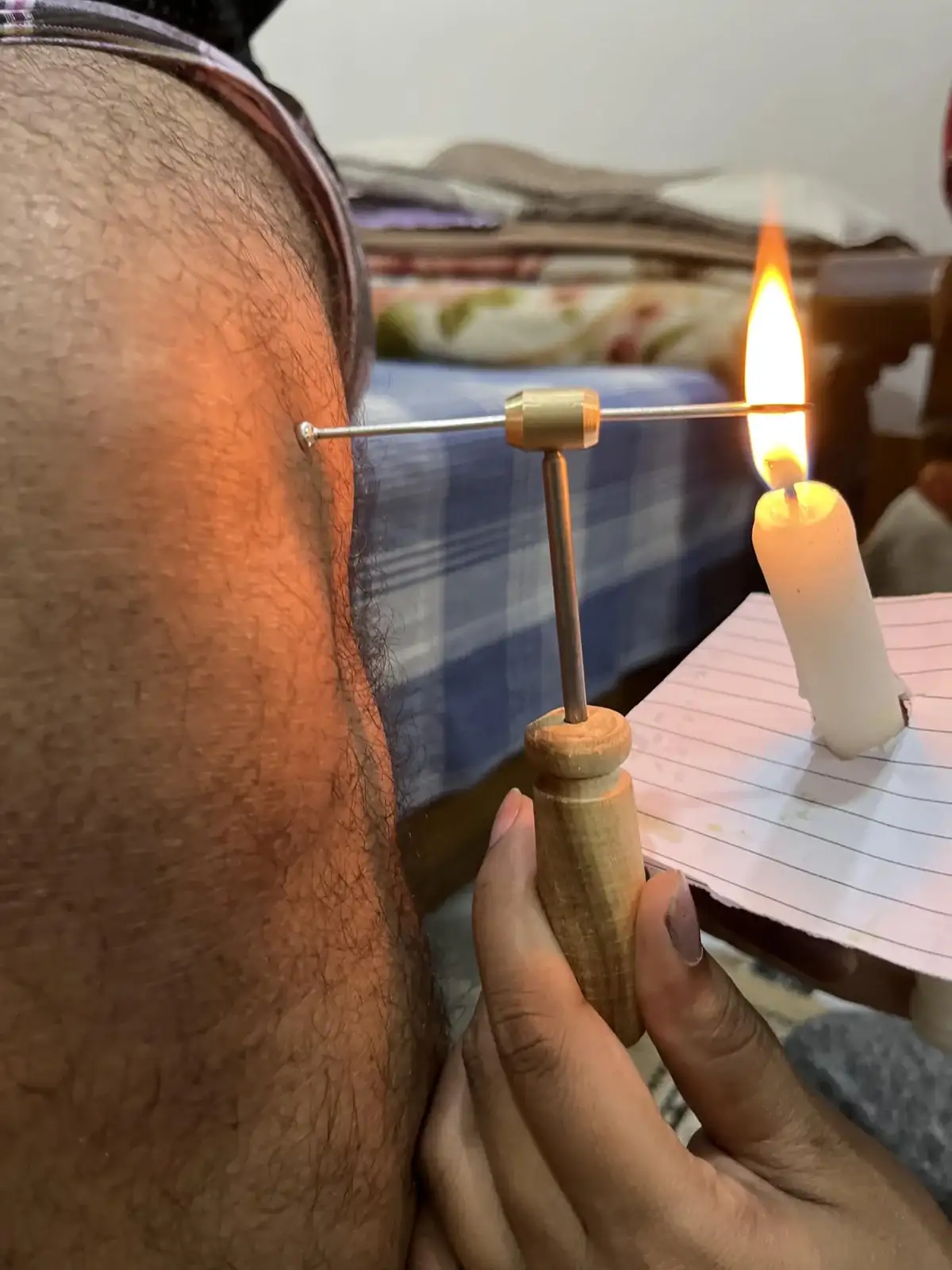 Agnikarma: a metal shalaka, heated in a candle flame, touched to a point on the side of the leg