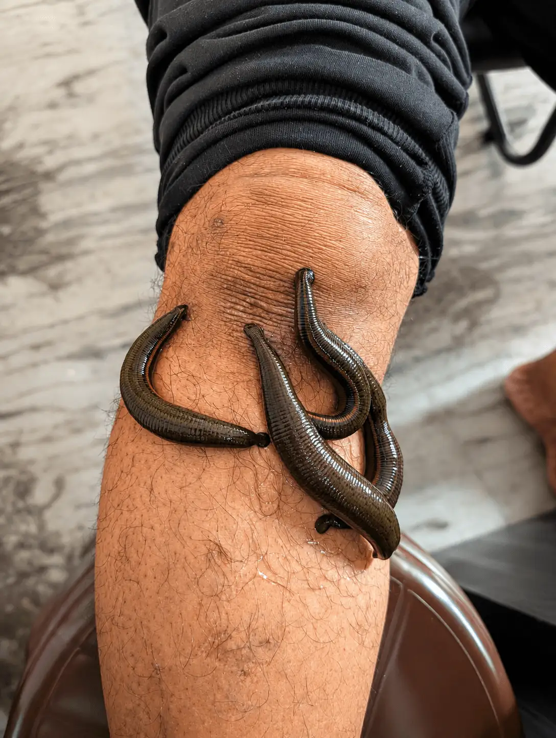 Leech therapy near the knee at Ayurveda Gokulam Clinic, doctor-supervised