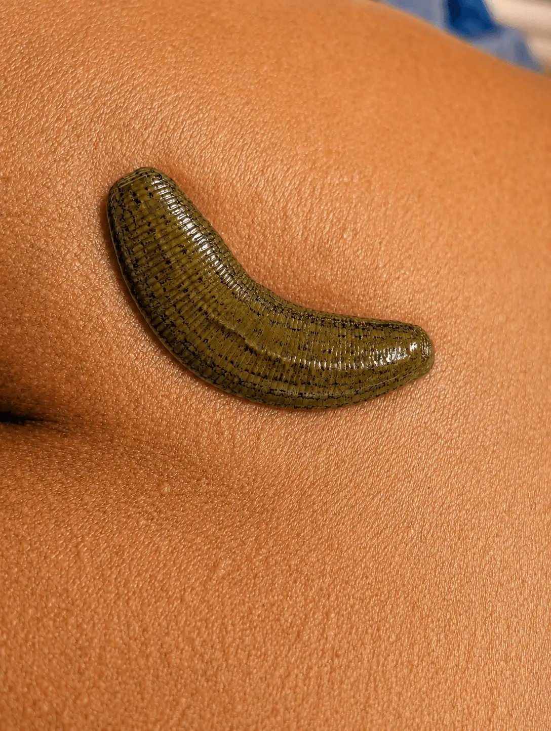 Medicinal leech applied during Raktamokshana therapy at Ayurveda Gokulam, Indore