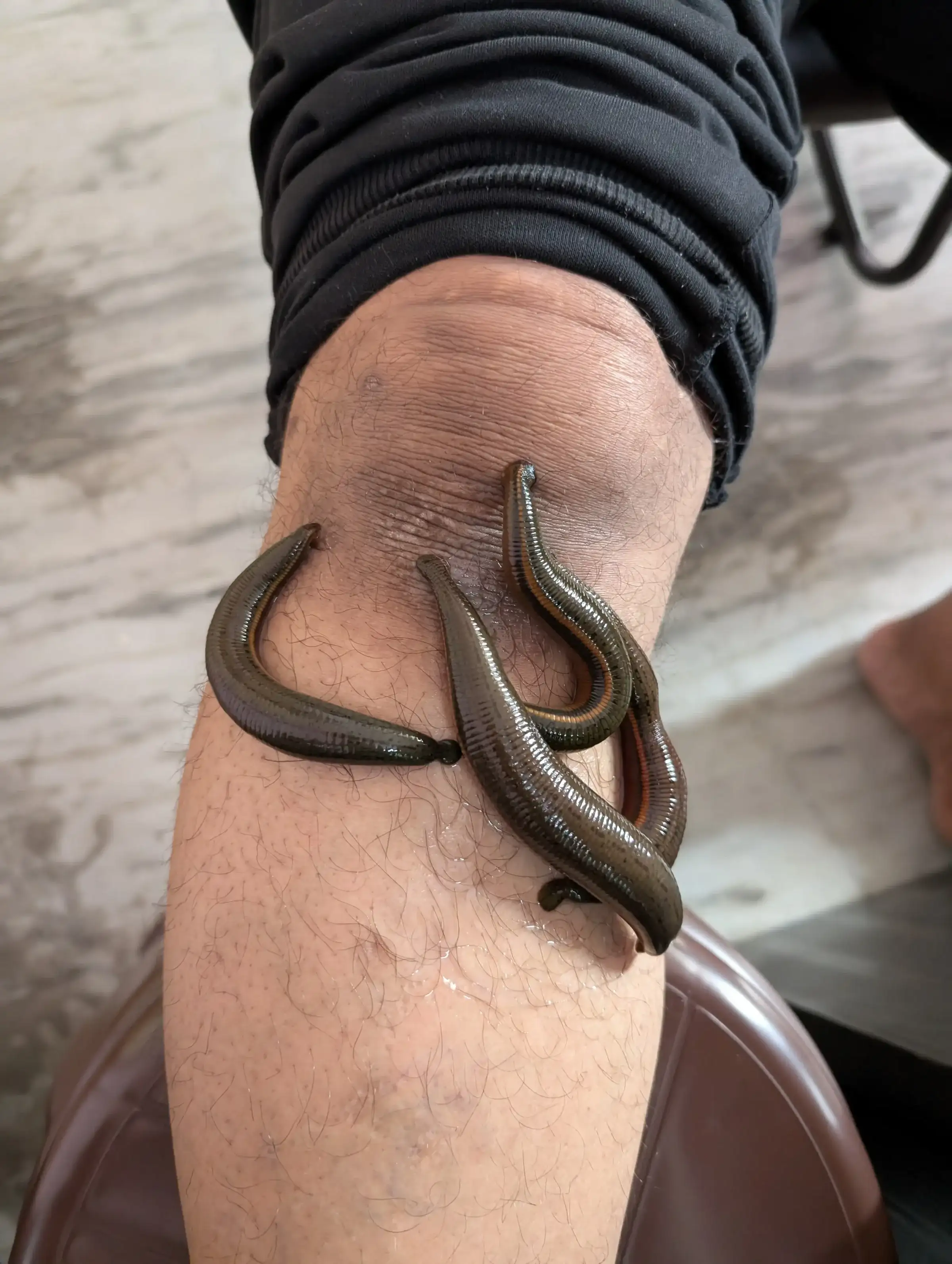 Leech therapy (Raktamokshana) in progress at Ayurveda Gokulam, Indore