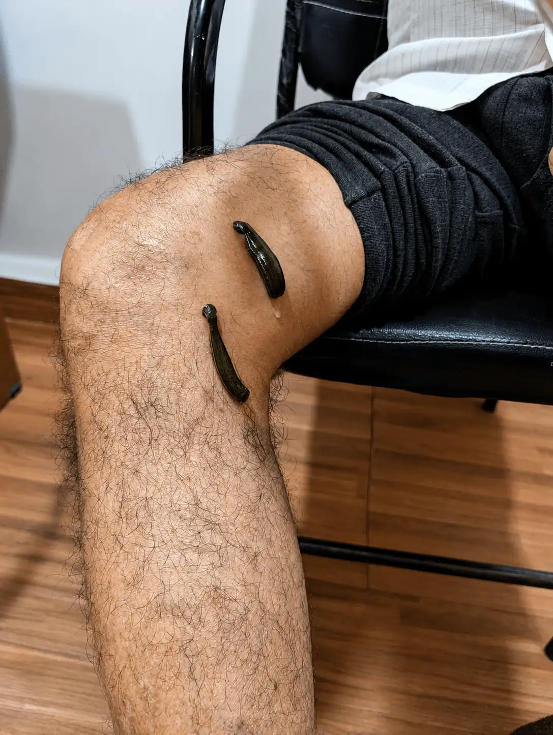 Leech therapy (Raktamokshana) being performed on the legs for varicose veins at Ayurveda Gokulam, Indore